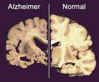 /album/portefolio-de-psicologia-/alzheimer-jpg/